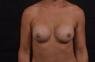 Breast Augmentation Silicone Gel Before & After Gallery - Patient 327039 - Image 2