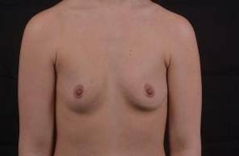 Breast Augmentation Silicone Gel Before & After Gallery - Patient 324281 - Image 1