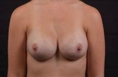 Breast Augmentation Silicone Gel Before & After Gallery - Patient 324281 - Image 2