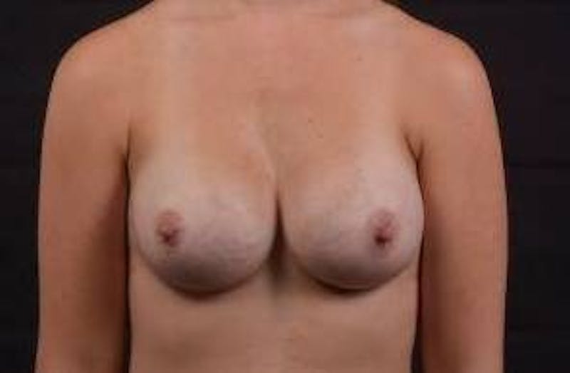 Breast Augmentation Silicone Gel Before & After Gallery - Patient 324281 - Image 2