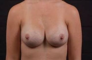 Breast Augmentation Silicone Gel Before & After Gallery - Patient 324281 - Image 2