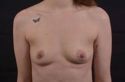 Breast Augmentation Silicone Gel Before & After Gallery - Patient 324312 - Image 1