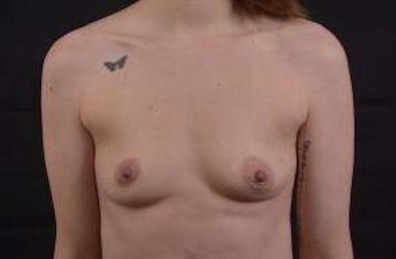 Breast Augmentation Silicone Gel Before & After Gallery - Patient 324312 - Image 1