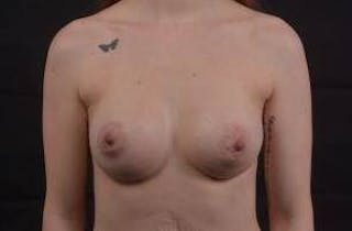 Breast Augmentation Silicone Gel Before & After Gallery - Patient 324312 - Image 2