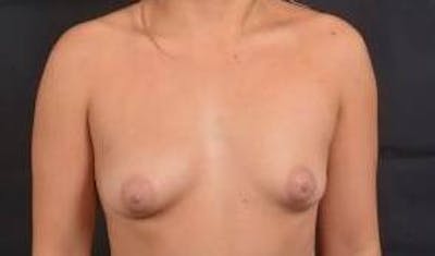 Breast Augmentation Silicone Gel Before & After Gallery - Patient 279515 - Image 1