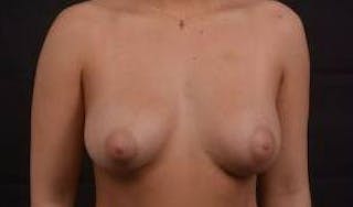 Breast Augmentation Silicone Gel Before & After Gallery - Patient 279515 - Image 2