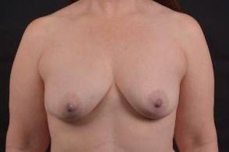 Breast Augmentation Silicone Gel Before & After Gallery - Patient 367191 - Image 1