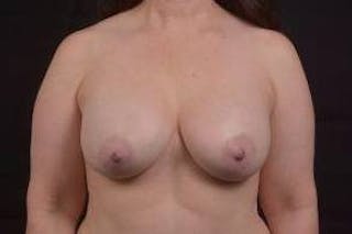 Breast Augmentation Silicone Gel Before & After Gallery - Patient 367191 - Image 2