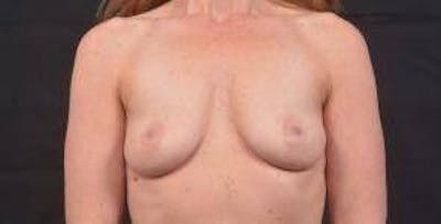 Breast Augmentation Silicone Gel Before & After Gallery - Patient 319826 - Image 1