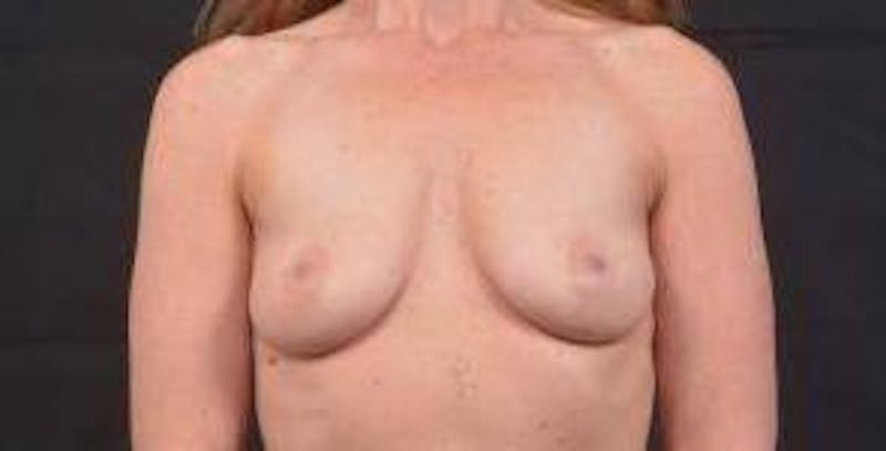 Breast Augmentation Silicone Gel Before & After Gallery - Patient 319826 - Image 1