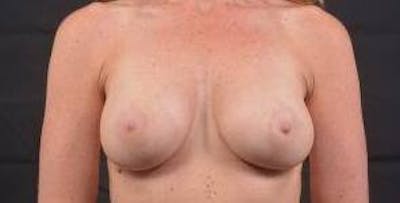 Breast Augmentation Silicone Gel Before & After Gallery - Patient 319826 - Image 2