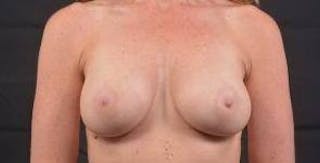 Breast Augmentation Silicone Gel Before & After Gallery - Patient 319826 - Image 2