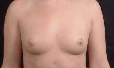Breast Augmentation Silicone Gel Before & After Gallery - Patient 267112 - Image 1