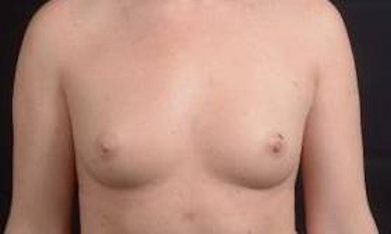 Breast Augmentation Silicone Gel Before & After Gallery - Patient 267112 - Image 1
