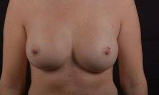Breast Augmentation Silicone Gel Before & After Gallery - Patient 267112 - Image 2