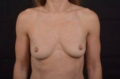 Breast Augmentation Silicone Gel Before & After Gallery - Patient 171893 - Image 1