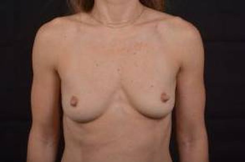 Breast Augmentation Silicone Gel Before & After Gallery - Patient 171893 - Image 1