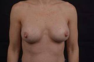 Breast Augmentation Silicone Gel Before & After Gallery - Patient 171893 - Image 2