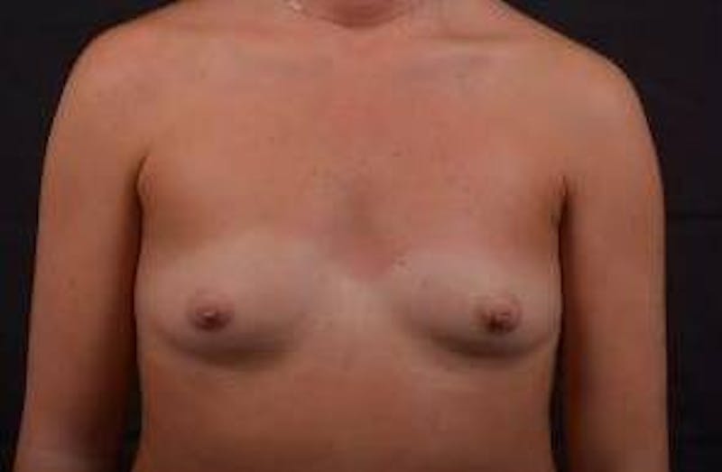 Breast Augmentation Silicone Gel Before & After Gallery - Patient 204200 - Image 1