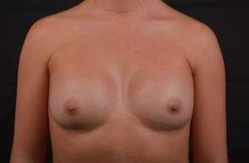 Breast Augmentation Silicone Gel Before & After Gallery - Patient 204200 - Image 2