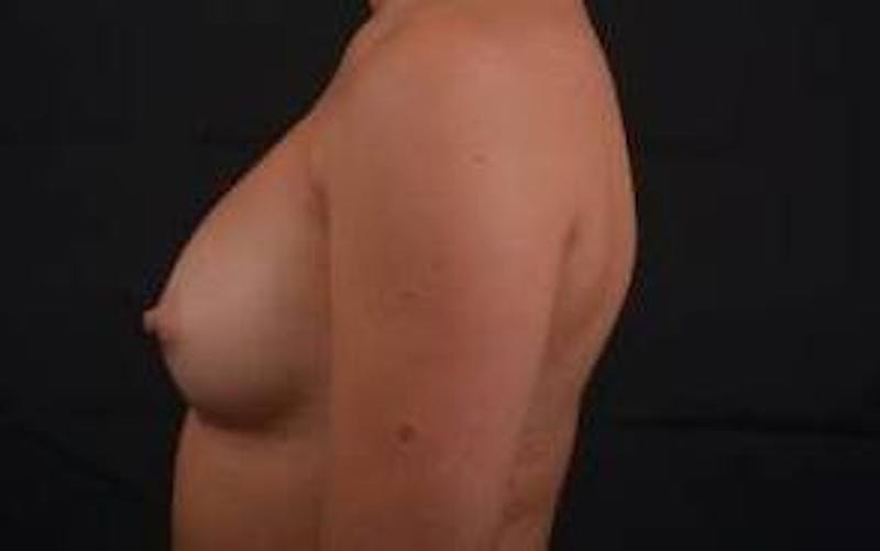 Breast Augmentation Silicone Gel Before & After Gallery - Patient 204200 - Image 4