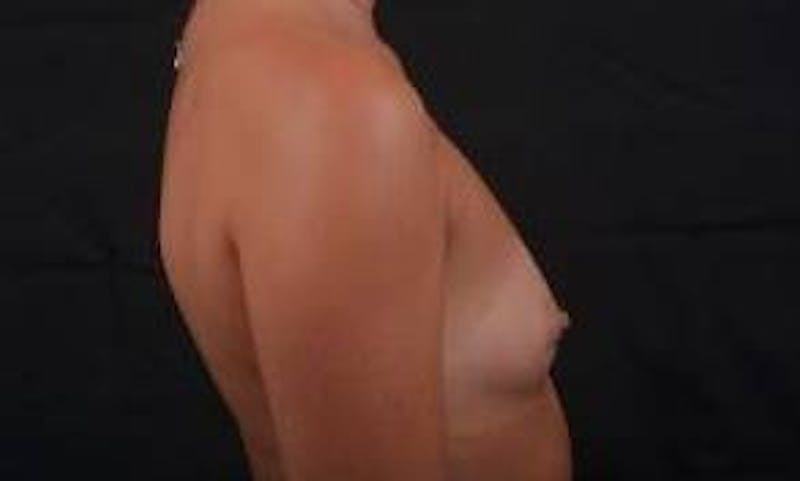 Breast Augmentation Silicone Gel Before & After Gallery - Patient 204200 - Image 5