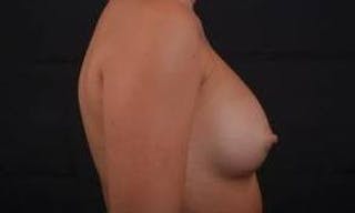Breast Augmentation Silicone Gel Before & After Gallery - Patient 204200 - Image 6