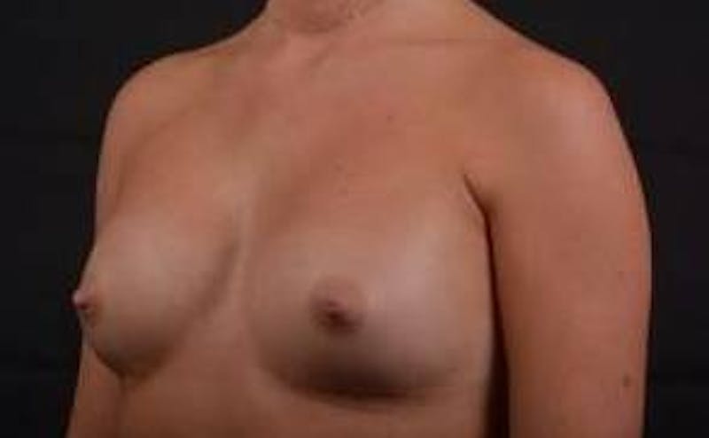 Breast Augmentation Silicone Gel Before & After Gallery - Patient 204200 - Image 8