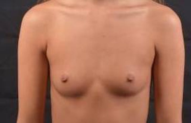 Breast Augmentation Silicone Gel Before & After Gallery - Patient 257979 - Image 1