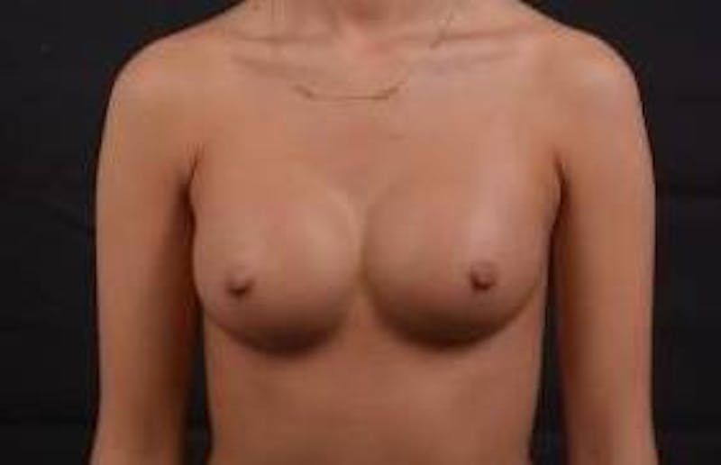 Breast Augmentation Silicone Gel Before & After Gallery - Patient 257979 - Image 2
