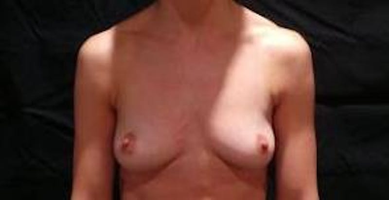 Breast Augmentation Silicone Gel Before & After Gallery - Patient 122289 - Image 1