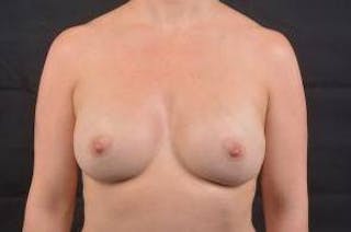 Breast Augmentation Silicone Gel Before & After Gallery - Patient 168265 - Image 2