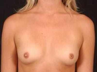 Breast Augmentation Silicone Gel Before & After Gallery - Patient 234729 - Image 1