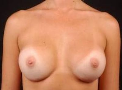 Breast Augmentation Silicone Gel Before & After Gallery - Patient 234729 - Image 2