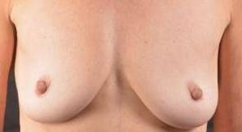 Breast Augmentation Silicone Gel Before & After Gallery - Patient 272818 - Image 1