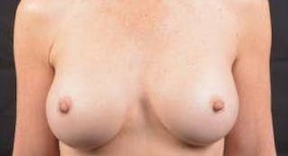Breast Augmentation Silicone Gel Before & After Gallery - Patient 272818 - Image 2