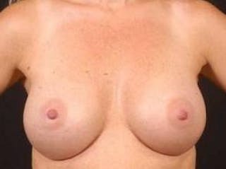 Breast Augmentation Silicone Gel Before & After Gallery - Patient 490916 - Image 2
