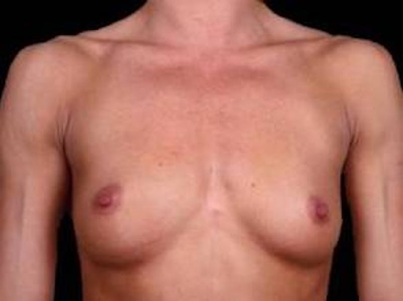 Breast Augmentation Silicone Gel Before & After Gallery - Patient 190938 - Image 1