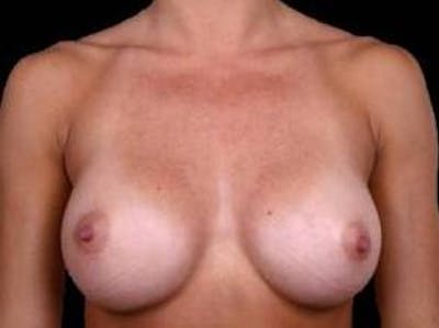 Breast Augmentation Silicone Gel Before & After Gallery - Patient 190938 - Image 2