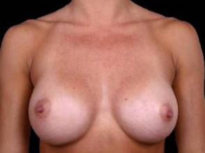 Breast Augmentation Silicone Gel Before & After Gallery - Patient 190938 - Image 2