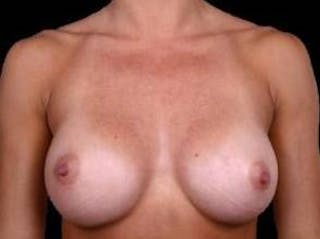 Breast Augmentation Silicone Gel Before & After Gallery - Patient 190938 - Image 2