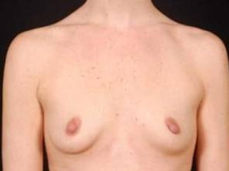 Breast Augmentation Silicone Gel Before & After Gallery - Patient 331851 - Image 1