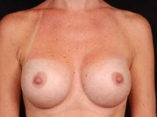 Breast Augmentation Silicone Gel Before & After Gallery - Patient 331851 - Image 2
