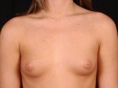 Breast Augmentation Silicone Gel Before & After Gallery - Patient 360509 - Image 1