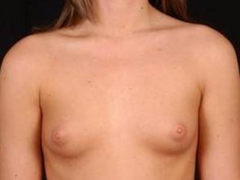 Breast Augmentation Silicone Gel Before & After Gallery - Patient 360509 - Image 1