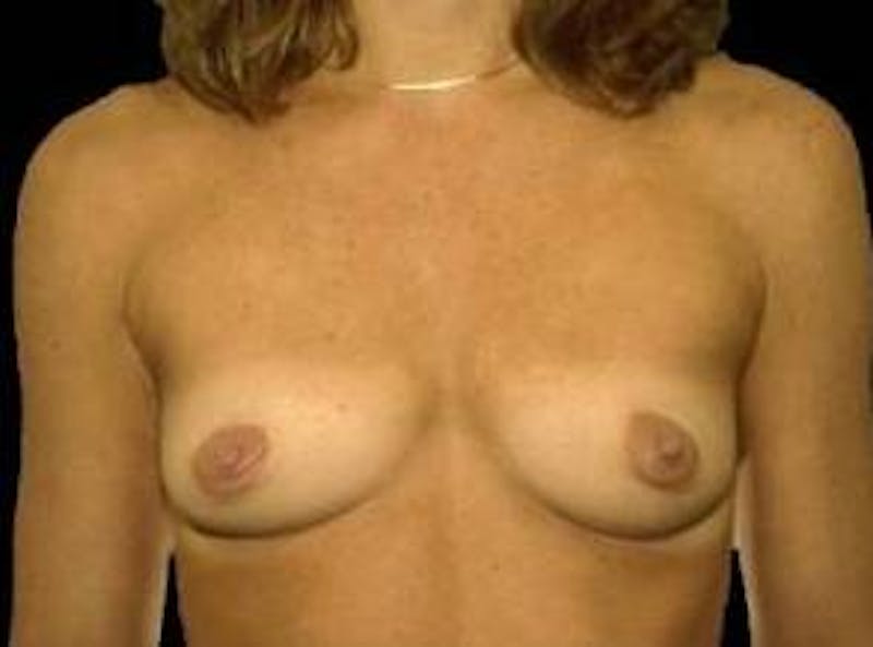 Breast Augmentation Silicone Gel Before & After Gallery - Patient 275675 - Image 1