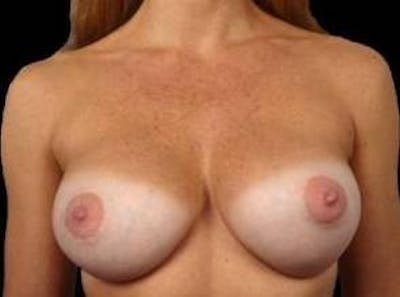 Breast Augmentation Silicone Gel Before & After Gallery - Patient 275675 - Image 2
