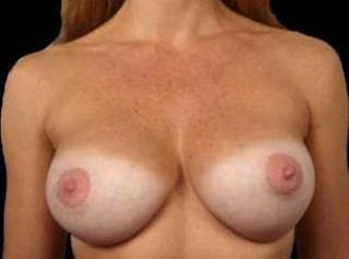 Breast Augmentation Silicone Gel Before & After Gallery - Patient 275675 - Image 2