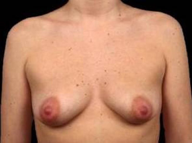 Breast Augmentation Silicone Gel Before & After Gallery - Patient 206947 - Image 1
