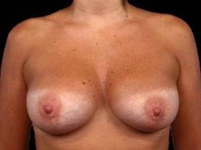 Breast Augmentation Silicone Gel Before & After Gallery - Patient 206947 - Image 2